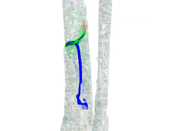 How We Define Patient-Specific Weight-Bearing Protocol