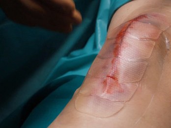 Leukomed® Control, Fully Transparent Post-Operative Dressing