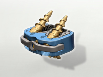 Lincotek’s SpineLinc new Cervical Implant System