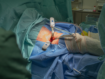 The Gripper™ System in use