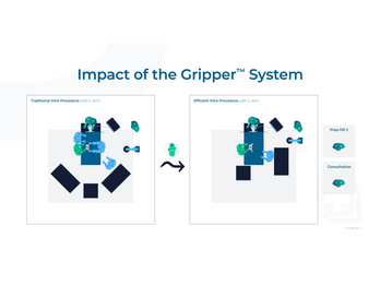 The impact of the Gripper™ System