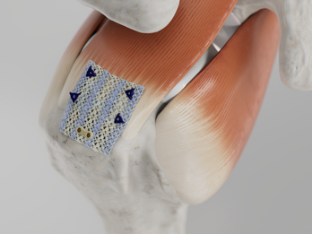 Integrity Implant for Rotator Cuff Repair