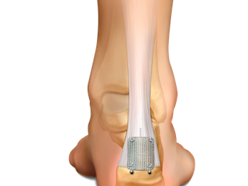 Integrity Implant for Achilles Tendon Repair