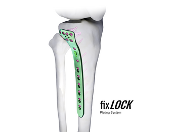 fixLOCK Plating System