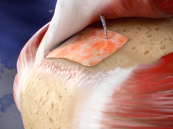 ROTIUM Bioresorbable Wick Holds Biology at the Enthesis RCR