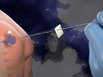 Implantation of ROTIUM