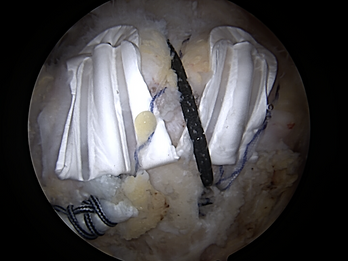 Arthroscopic BioCharge Autobiologic Matrix Construct