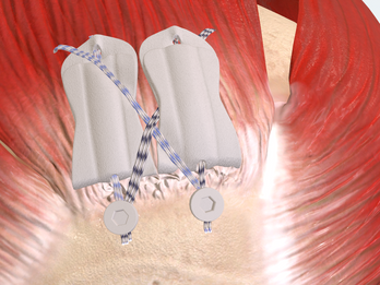 BioCharge Implant Animated for RCR