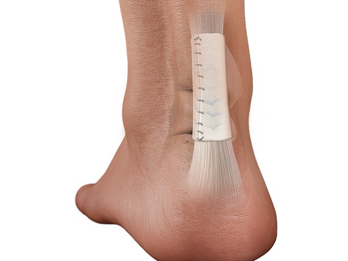 ROTIUM wrapped around Achilles tendon