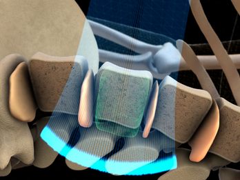Radiation-free bone density measurement with Echolight