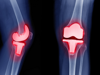 Understanding Periprosthetic Joint Infections (PJIs)