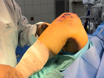 Patella Plating System - Locking Plate w/ Integrated Sutures