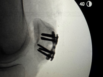 Low Profile Anatomical Locking Plate