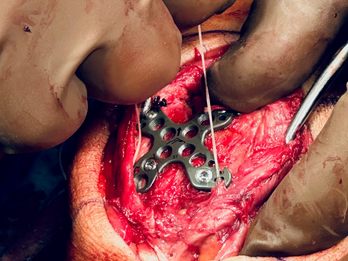 Integrated Sutures for Complete Extensor Mechanism Repair