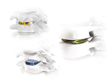 INTERVERTEBRAL CAGES