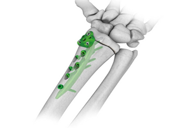 RADIAL NAIL