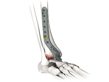ANKLE ARTHRODESIS PLATES