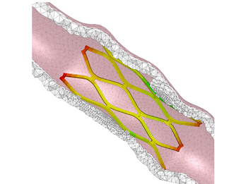 Coronary stent placement
